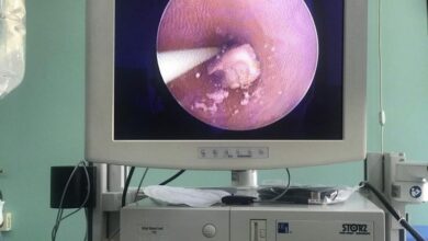 Photo of Në Spitalin e Gostivarit bëhet thyerja e gurit në kanal urinar me Holmium laserit