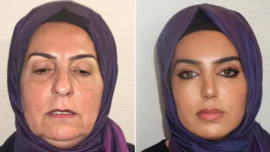 Photo of A është e njëjti person? – Njerëzit nuk mund ta besojnë ndryshimin e madh pas ndërhyrjeve që bëri kjo grua në një klinikë në Turqi