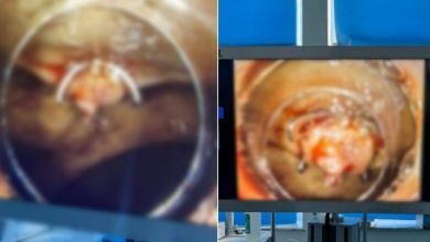 Photo of Rasti i dytë i ndërprerjes së gjakderdhjes masive nga stomaku, procedura Ovesco Klip kryhet në Klinikën e Gastroenterologjisë