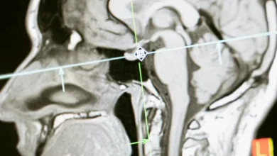 Photo of Çfarë është “brain fog”? Këto janë zbërthimet që shkencëtarët po i zbulojnë
