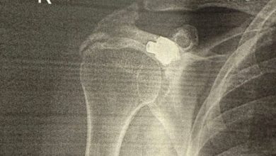 Photo of “Plumbi që mbijetoi 27 vjet në trupin tim” – Rrëfimi i Gramoz Berishës në 18-vjetorin e Pavarësisë