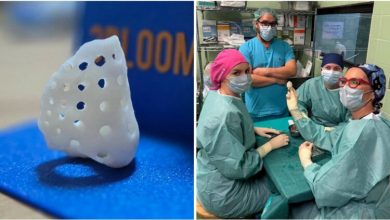 Photo of Për herë të parë në Maqedoni dhe rajon: Ndërhyrje kirurgjikale me një implant hunde të printuar në 3D